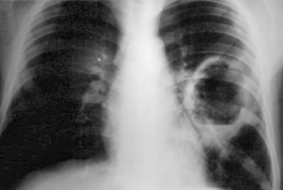 Абсцедирующая пневмония на рентгене
