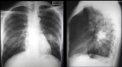 Очаговая пневмония на рентгене