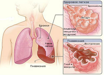 Проявления пневмонии