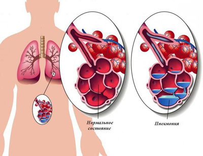 заболевание пневмонией