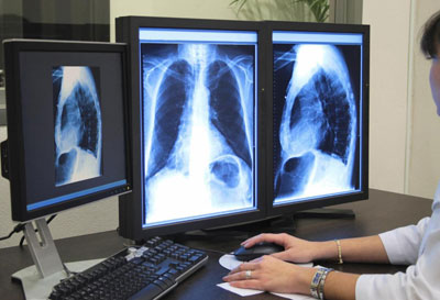 компьютерная томография лёгких