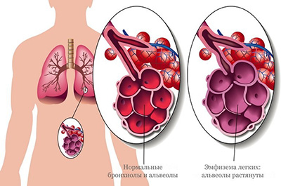 рисунок болезни легких