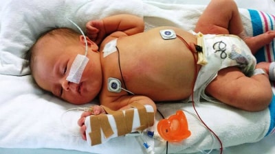 Сколько лечить пневмонию у новорожденного
